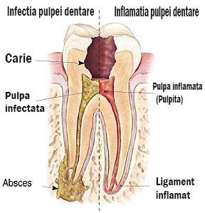 inflamatie-si-infectie-dentara