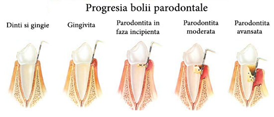 Bolile-Parodontale