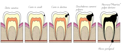 evolutia-cariei-dentare