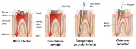 root-canal3