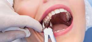 tooth-extractions-300x138.jpg